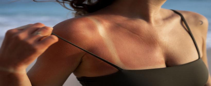 Verão alerta para prevenção do câncer de pele e o uso correto do protetor solar
